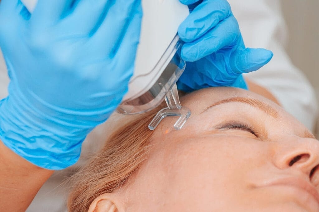 Why Everyone in Los Angeles Is Suddenly Getting CO2 Laser Treatments