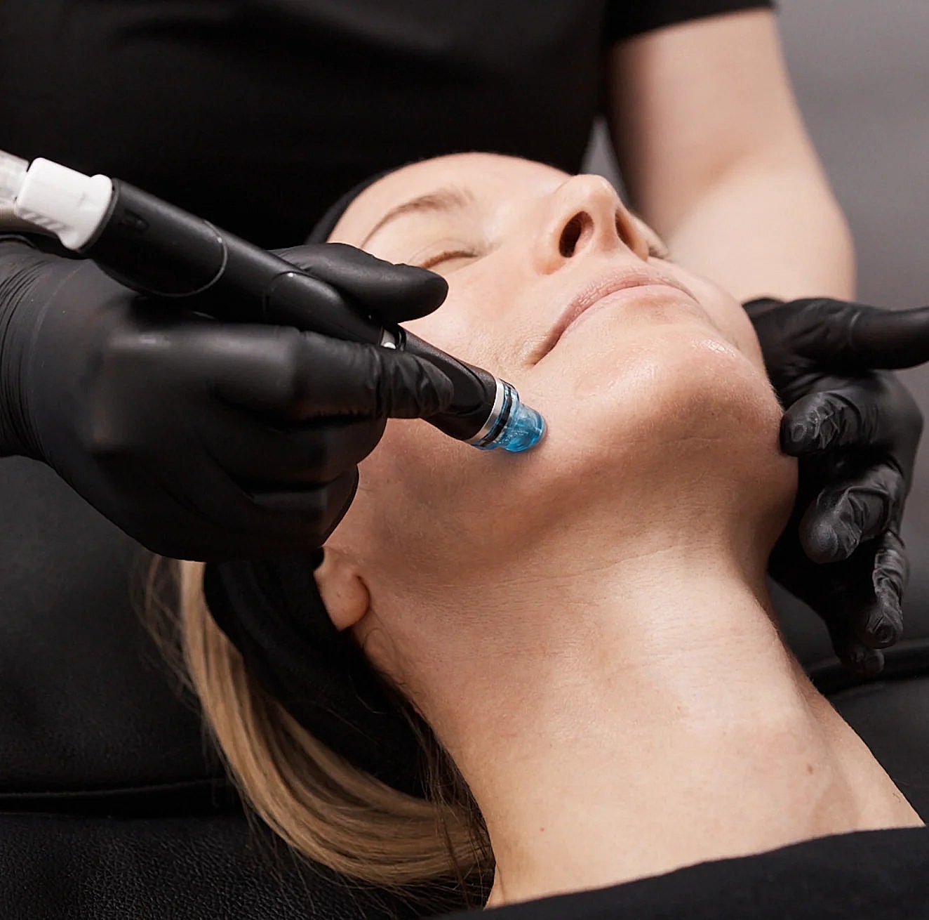 Microdermabrasion