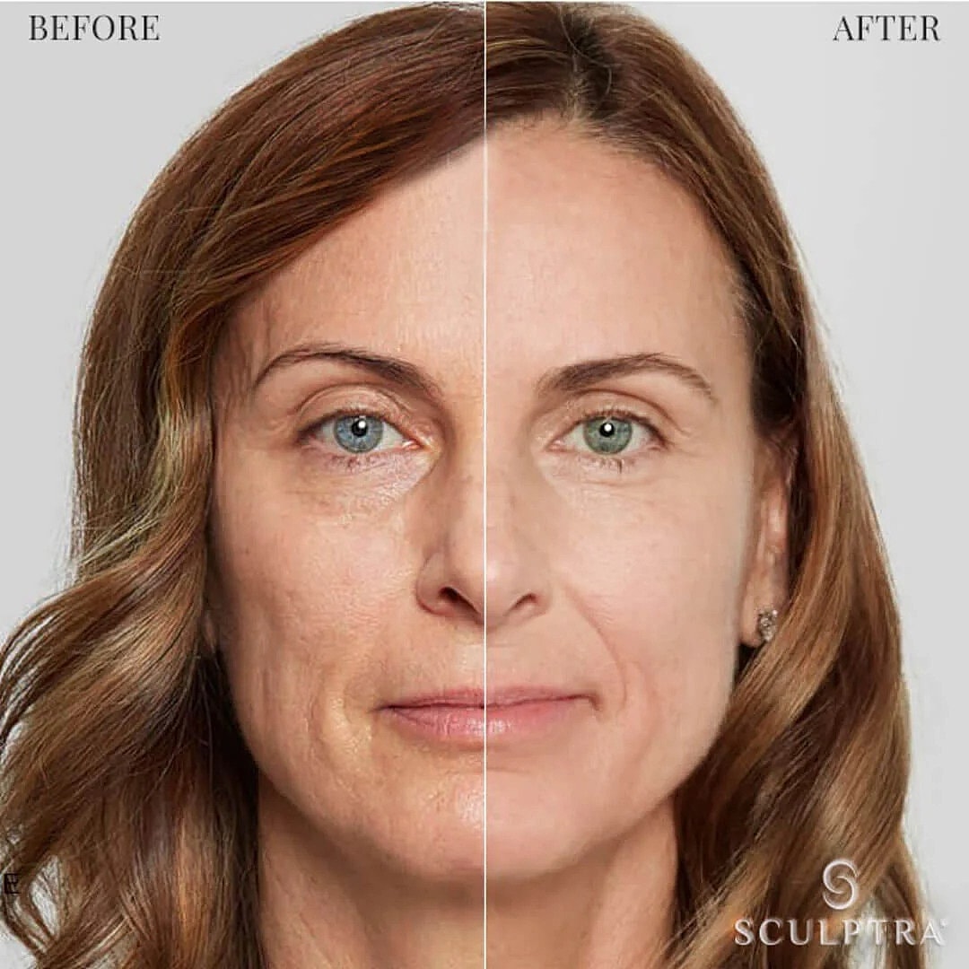 Sculptra® Overview
